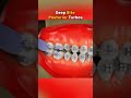 Deep Bite Correction with Posterior Turbos 3D Medical Animation #shorts #shortvideo #shortsfeed #yt