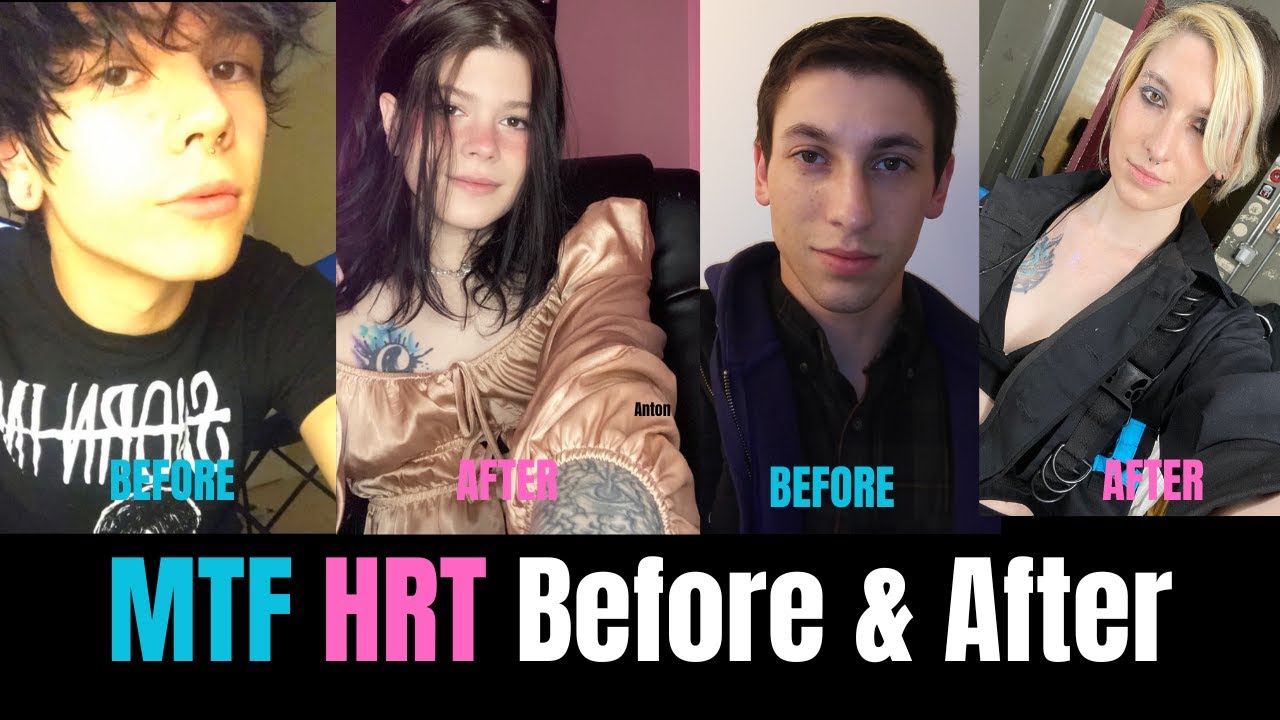 MTF Before vs After HRT: You Won’t Believe the Difference!