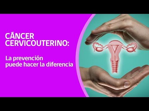 Cáncer cervicouterino: La