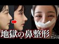 【鼻整形】壮絶な手術の様子を公開。全てはキレイになるために。