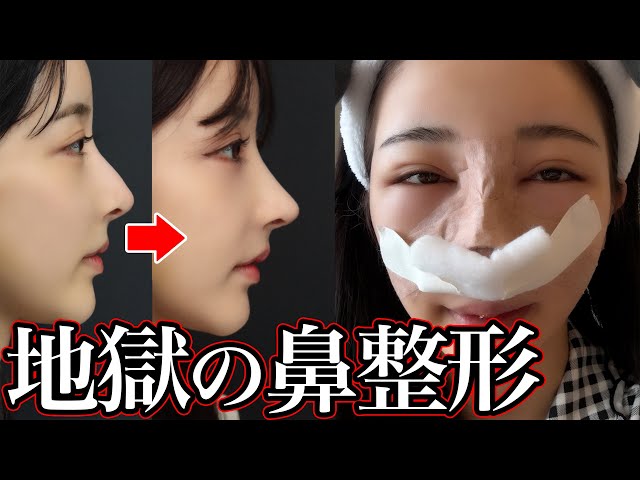 鼻整形】壮絶な手術の様子を公開。全てはキレイになるために。 - YouTube