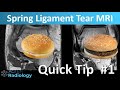 Easy Identification of Spring Ligament Tears on MRI - Quick Tip #1