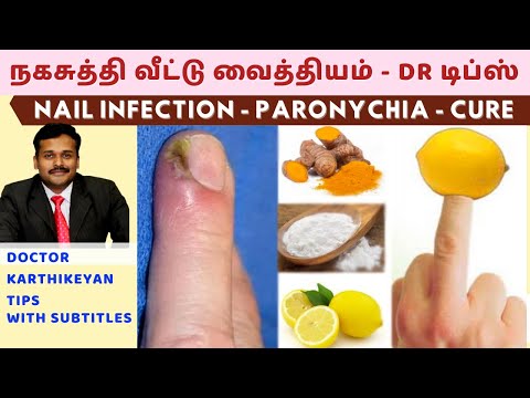 நகசுத்தி வந்தால் குணமாக வீட்டு வைத்தியம்|nail skin infection home remedies paronychia dr karthikeyan