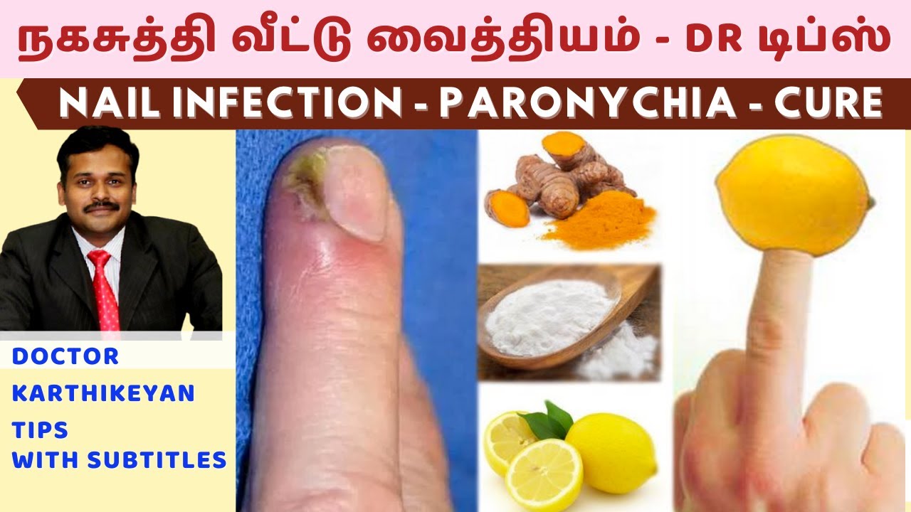 Tips to cure nail fungus..! | நகச் சொத்தை குணமாக டிப்ஸ்..! | Dinamalar