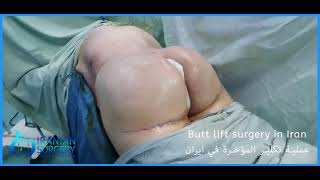 Butt lift surgery in Iran