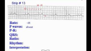 ECG: Exercise # 13