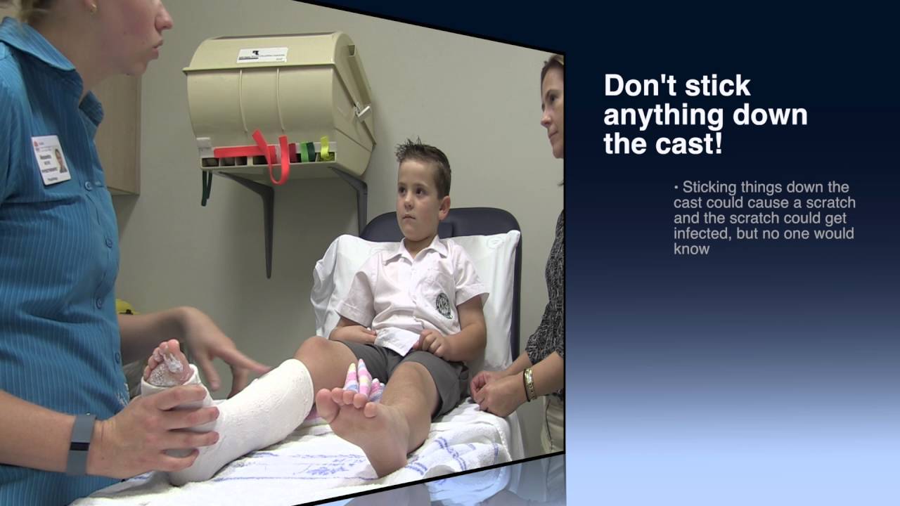 VIDEO: Caring for your cast, Tips to help your limb heal