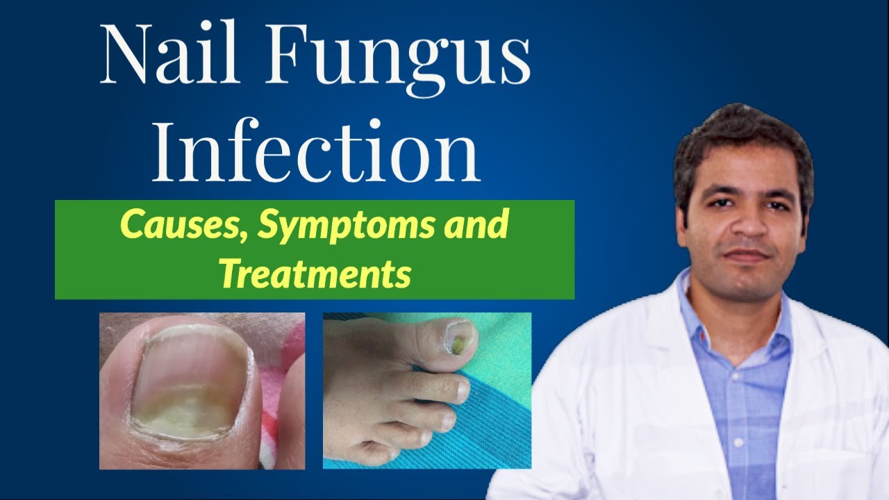 Fungal Nail Treatment | Onychomycosis | City Foot Health