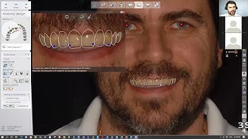 3Shape Dental System Snap on Smile Technique