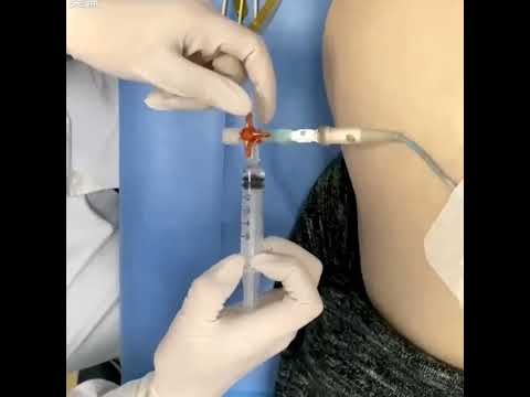 Drainage tubes during transitional care Video S4 500220