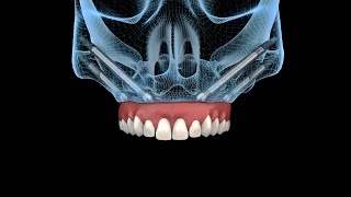 Zygomatic Implants - What is a zygomatic dental implants?