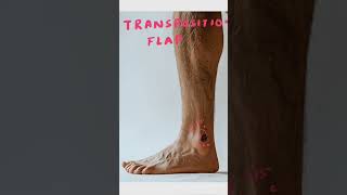 Transposition Flap in 60 Seconds | Plastic Surgery Explained #Shorts