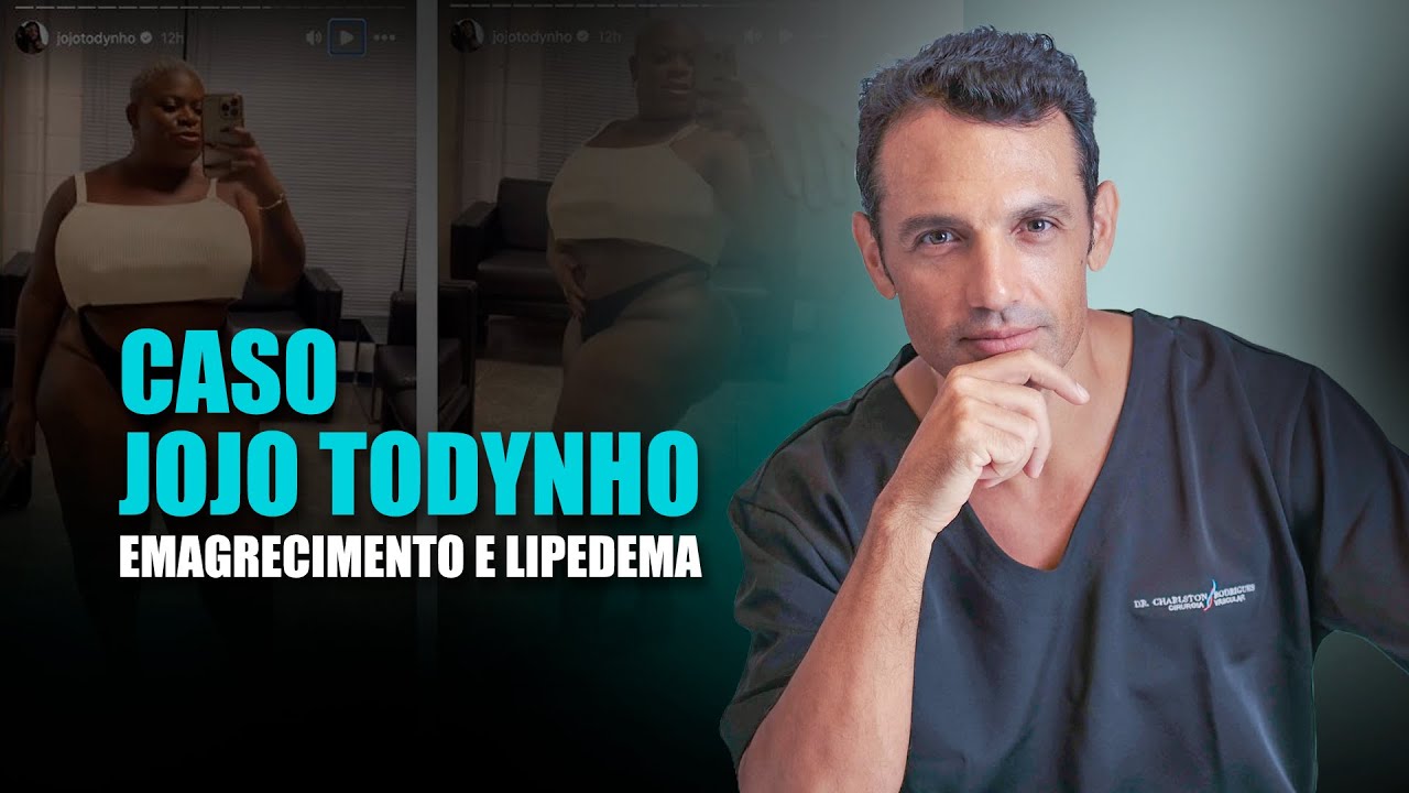 EMAGRECIMENTO E LIPEDEMA Caso Jojo Todynho | Dr. Charlston Rodrigues