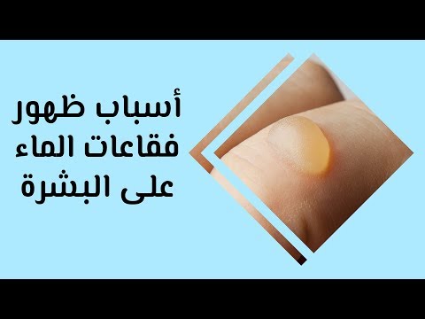 فيديو: ما هي اللدغة المائية؟