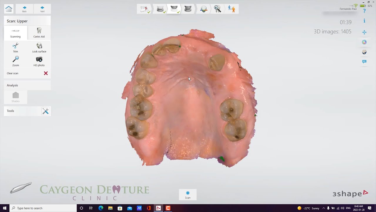 Intraoral Scans for Cast Partial Upper Denture