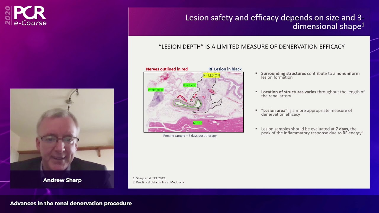 Advances in the renal denervation procedure - PCR e-Course 2020