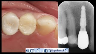 Dental Implant with 3D Planning & GBR by Dr Kuljeet Singh Mehta-Periodontist 1,888 views 10 months ago 12 minutes, 57 seconds