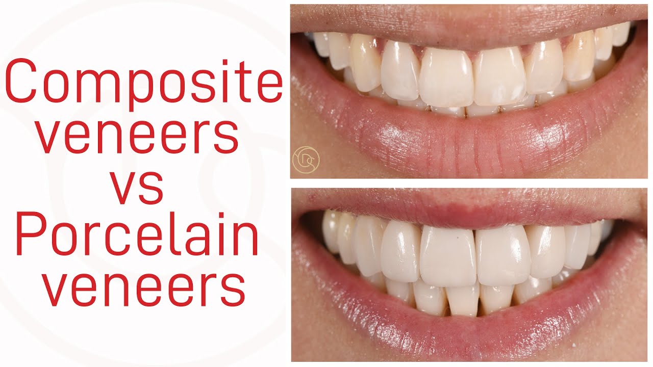 Different Types of Veneers
