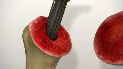 Shoulder arthroplasty surgery; surgical approach, cementing and implant positioning,