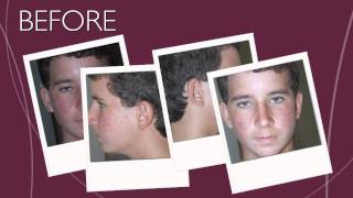 Marian Rubock   Acne Case Study