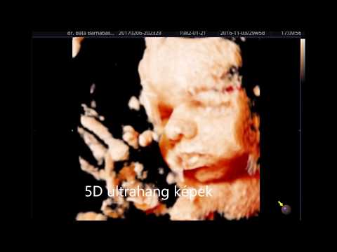 Videó: Különbség A 3D és A 4D Ultrahang Között