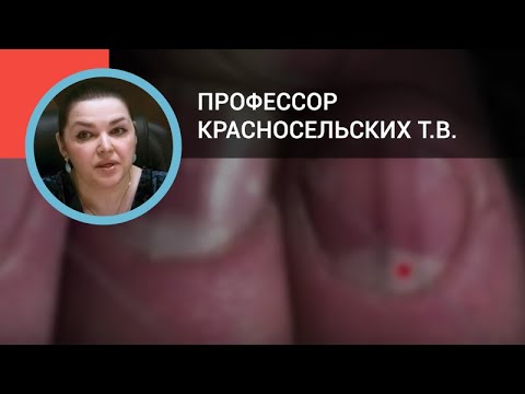 Видео: Екзема на кожата линия