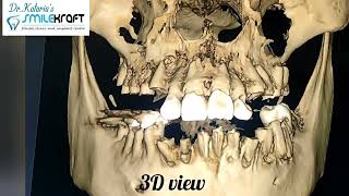 3D view of patient CBCT trendingshorts trendingshorts dentistry implantesdentarios