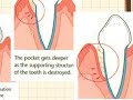 Diseases of Periodontium 2