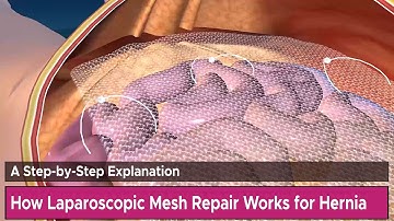 How Laparoscopic Mesh Repair Works for Hernia: A Step-by-Step Explanation
