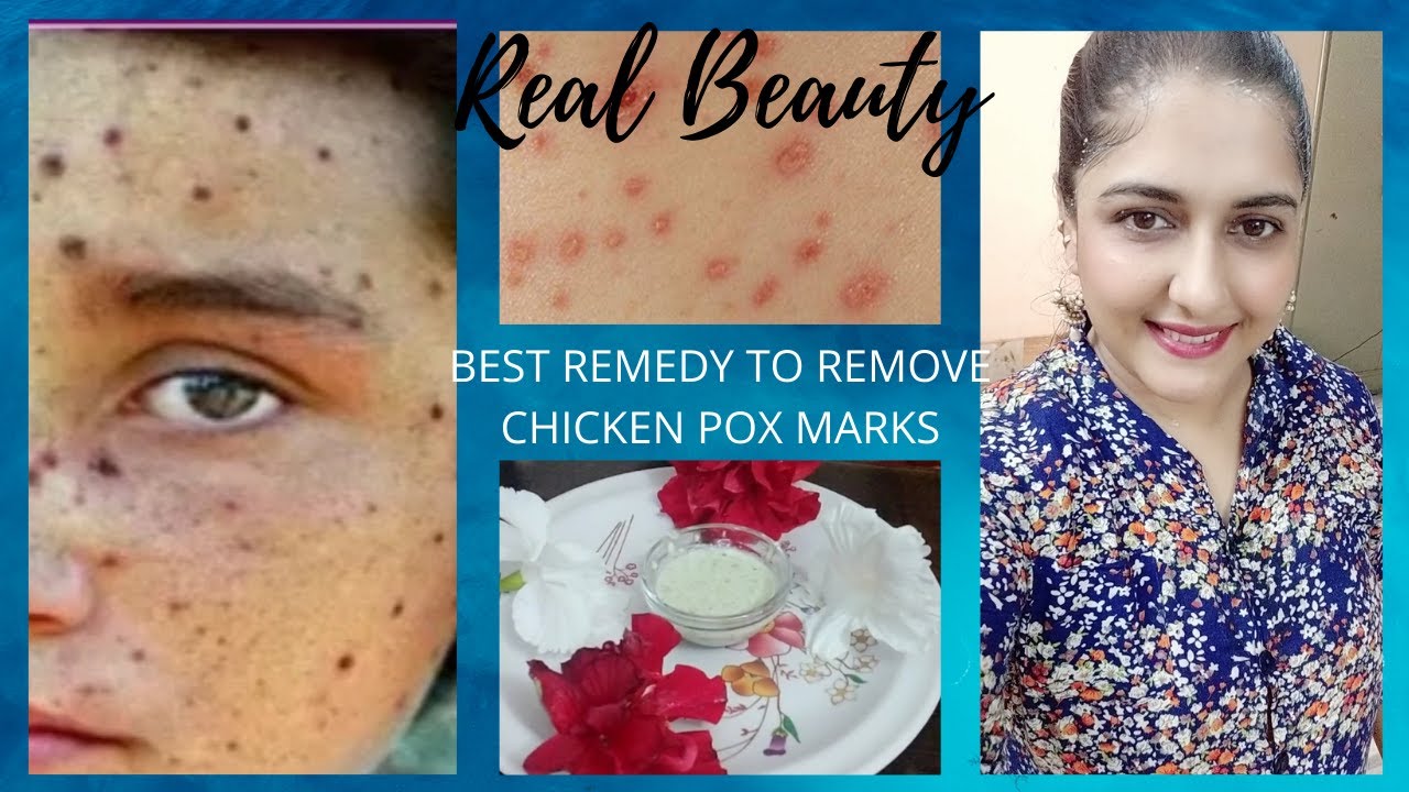 Chicken Pox Marks RemovalBest Remedy to Remove Chicken Pox Marks Get