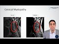 Cervical Myelopathy - What is it? How can we treat it?