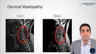 Cervical Myelopathy - What is it? How can we treat it?