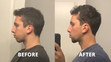 8 Month Mewing Before And After Transformation (From Treatment With Dr. Estrabillo)
