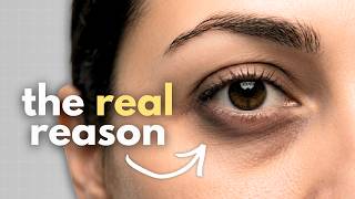 How to fix the dark circles under your eyes
