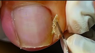 Uma doí, mas imagina duas #nails #satisfying 
