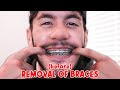 PREPARING FOR THE REMOVAL OF BRACES!
