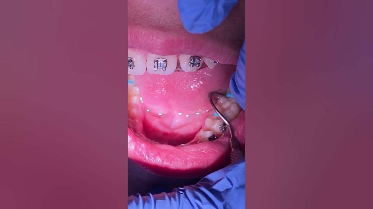 What is the worst part of having braces? Are you getting molar bands