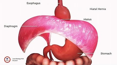 Surgery for acid reflux | Animation Video