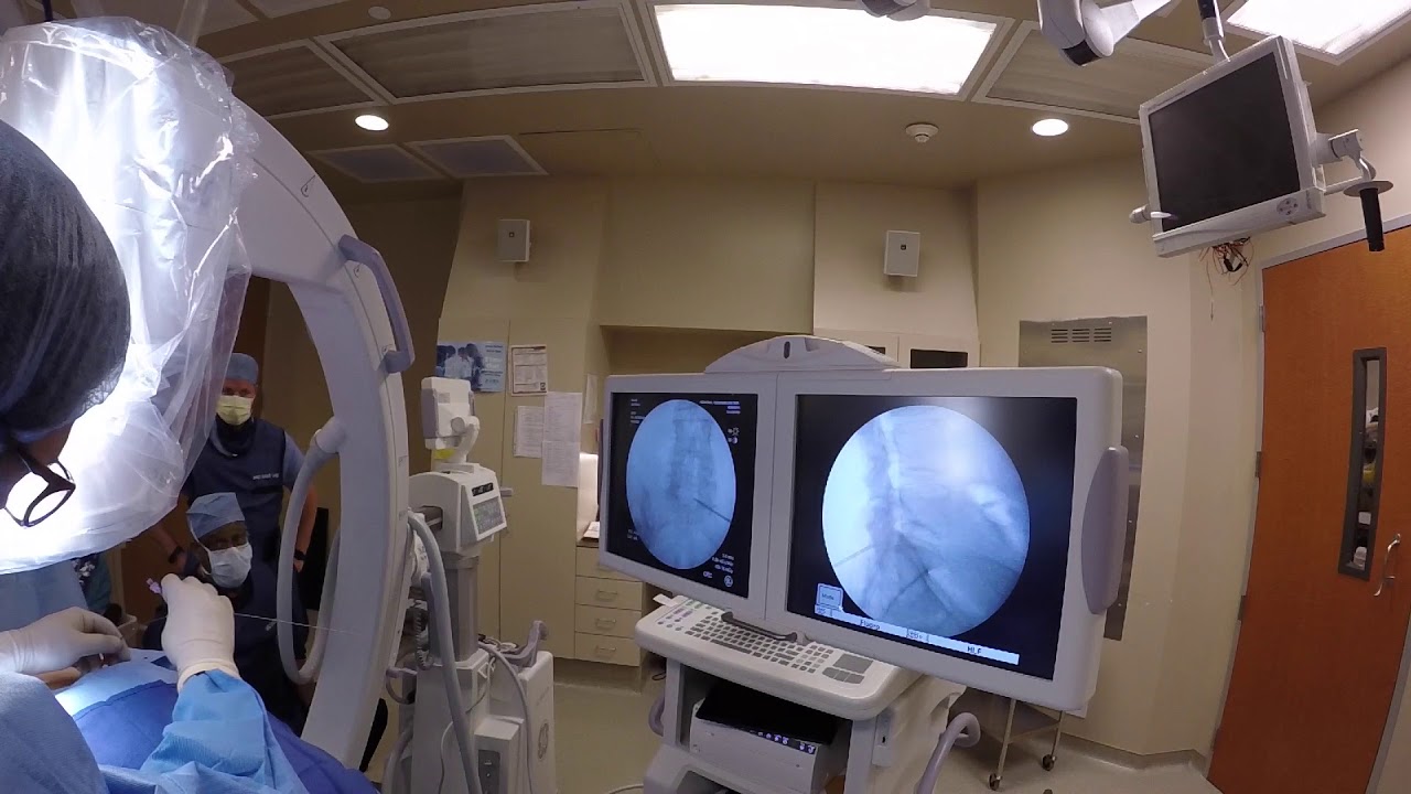 Neuromodulation Electrode Placement