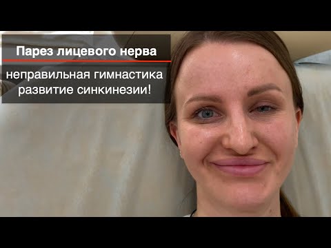 Парез лицевого нерва, неправильная гимнастика, развитие синкинезии!