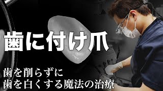 【ラミネートベニア】芸能人も多くやっている歯を白くする魔法の治療とは