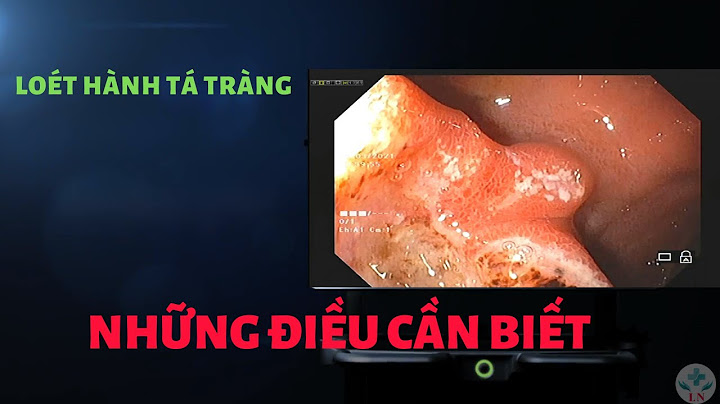 Hành tá tràng nằm ở vị trí nào năm 2024