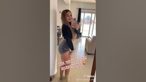 Non surgical BBL injections - My BBL with filler injectables!