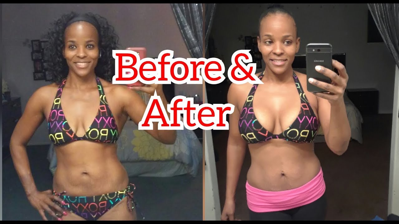 Breast Augmentation and Breast Implants Breast Augmentation and Breast Implants