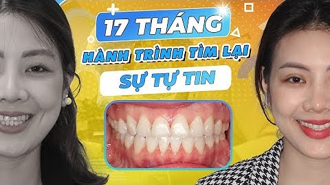 Niềng Răng Hành Trình Tìm Lại Nụ Cười Tự Tin Của Cô Giám Đốc Trẻ