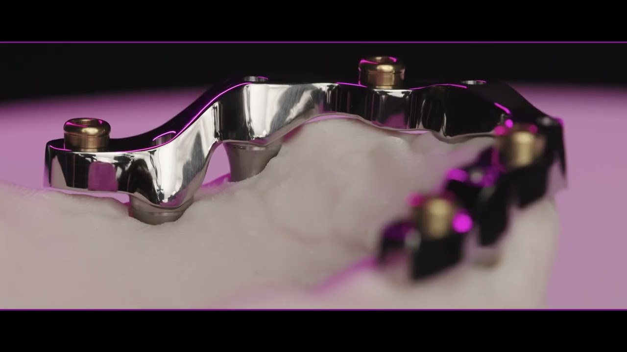 Milled bar on five Biomet implants