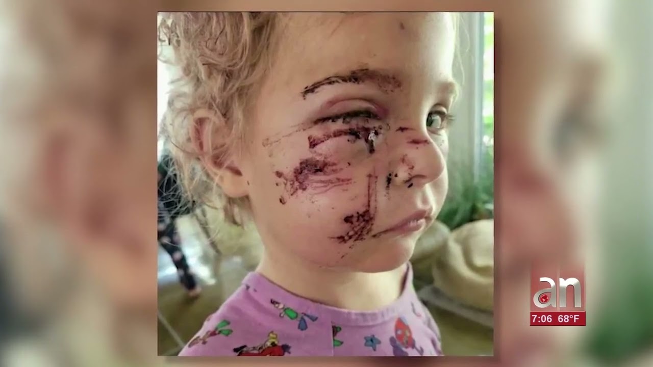americateve | Niña de 5 años es atacada brutalmente por un perro en un parque de Fort Lauderdale