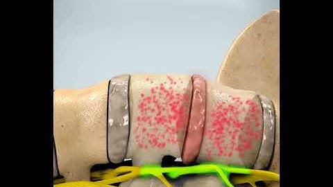 Decompression Lumbar