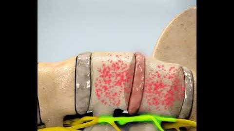 Decompression Lumbar