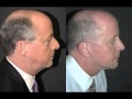 Male Facelift and Necklift Before and After by Top NYC Plastic Surgeon Dr Jacono #faceliftformen